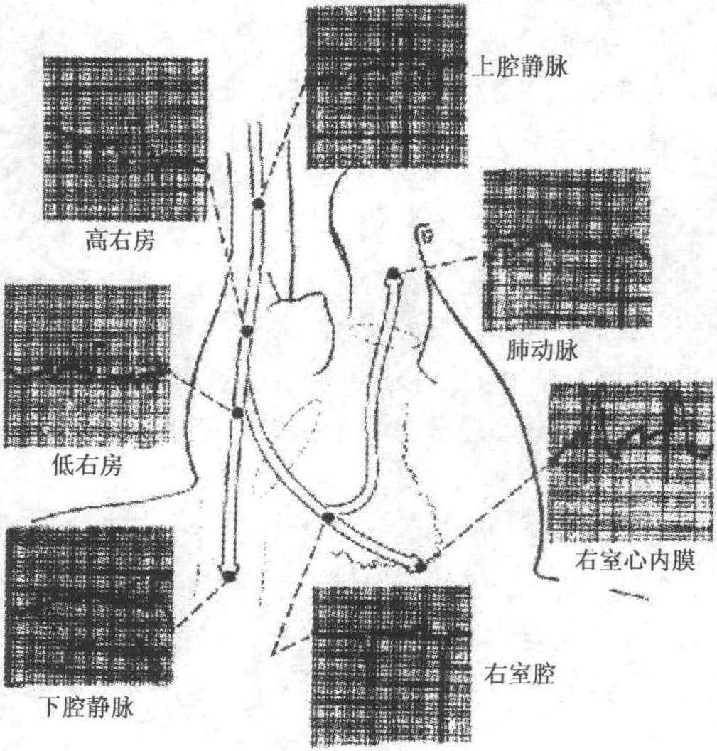 第三節(jié) 臨時起搏程序建立